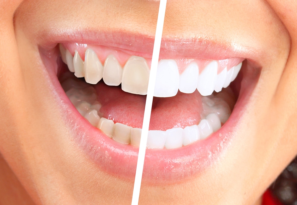 teeth whitening aurora