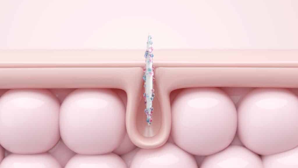Scarlet microneedling in aurora