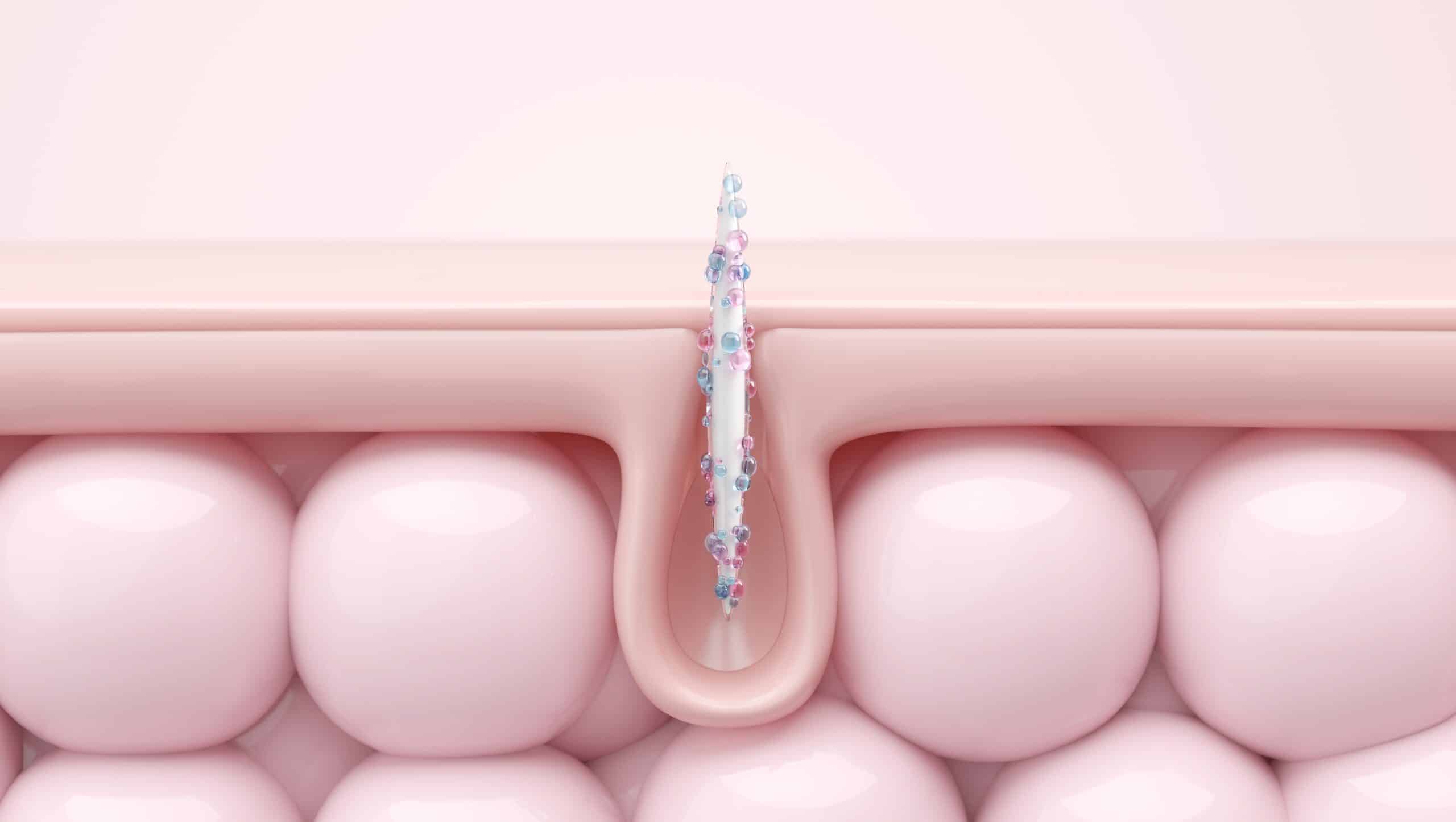 Scarlet microneedling in aurora