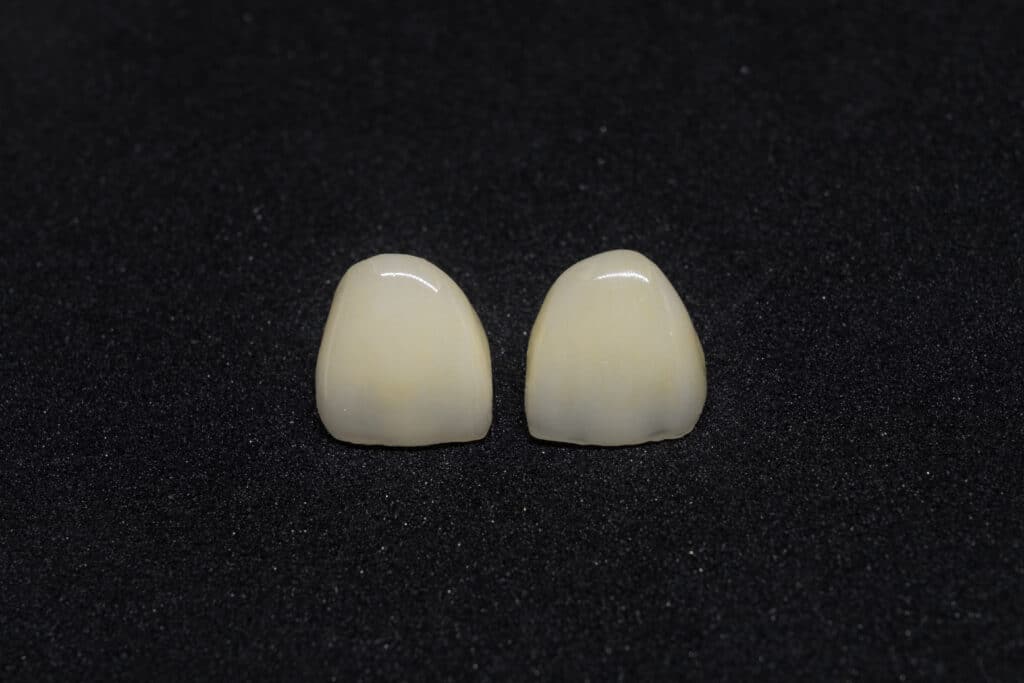 front tooth crown aurora