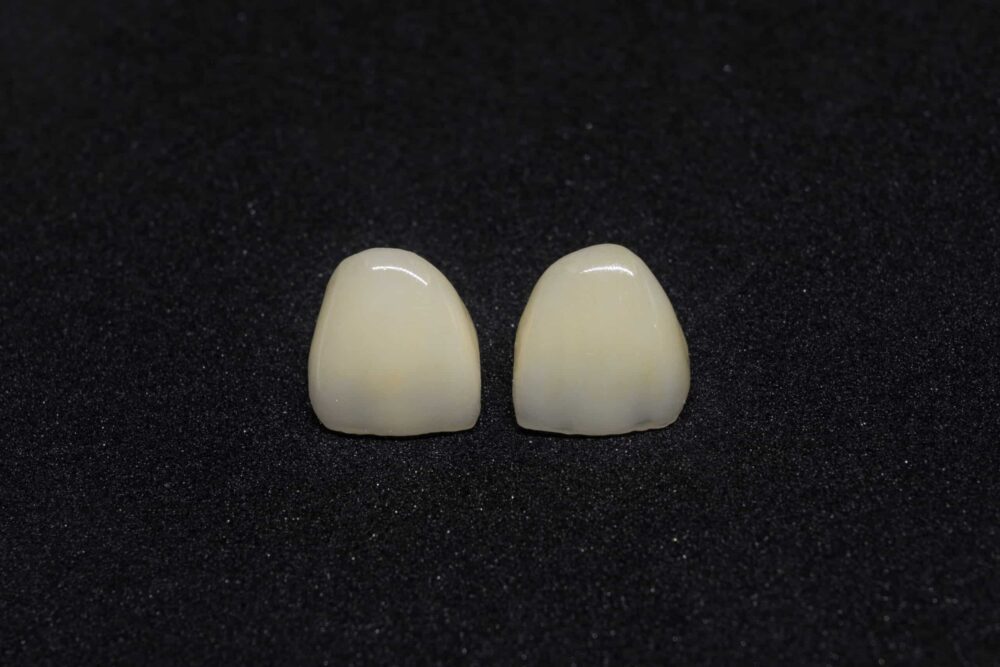 front tooth crown aurora